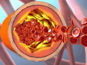 cholesterol