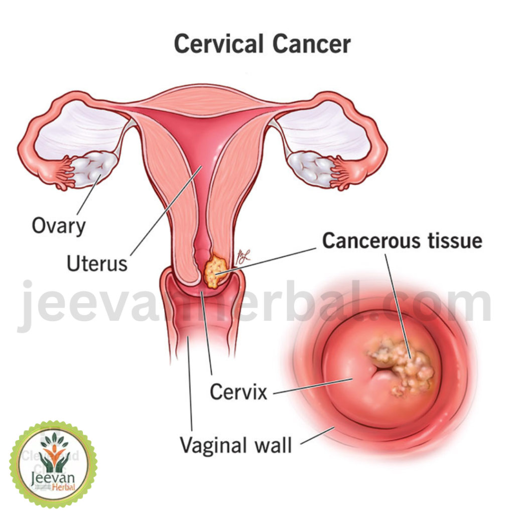 Cervical Cancer
